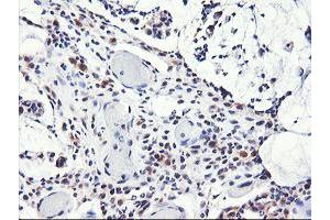 Immunohistochemical staining of paraffin-embedded Adenocarcinoma of Human colon tissue using anti-NLN mouse monoclonal antibody. (NLN anticorps)