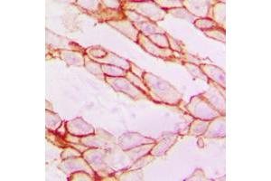 Immunohistochemical analysis of Paxillin staining in human breast cancer formalin fixed paraffin embedded tissue section. (Paxillin anticorps  (Center))