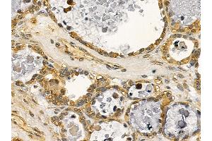 DRP1 Mouse Monoclonal Antibody at 1/100 staining human ovarian cancer by IHC-P. (Dynamin 1-Like anticorps  (C-Term))