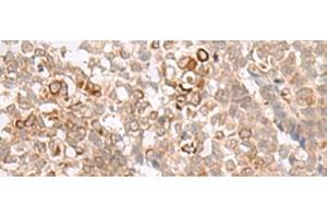 Immunohistochemistry of paraffin-embedded Human ovarian cancer tissue using MCAM Polyclonal Antibody at dilution of 1:40(x200) (MCAM anticorps)