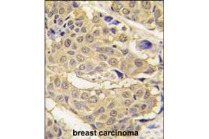 Formalin-fixed and paraffin-embedded human breast carcinoma tissue reacted with EPRS antibody , which was peroxidase-conjugated to the secondary antibody, followed by DAB staining. (EPRS anticorps  (N-Term))