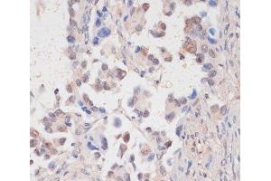 Immunohistochemistry of paraffin-embedded Human lung cancer using HTATSF1 Polyclonal Antibody at dilution of 1:100 (40x lens). (HTATSF1 anticorps)