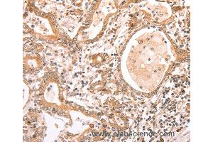 Immunohistochemistry of Human liver cancer using ABCF1 Polyclonal Antibody at dilution of 1:40 (ABCF1 anticorps)