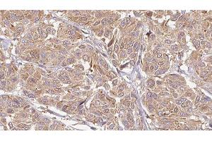 ABIN6276604 at 1/100 staining Human Melanoma tissue by IHC-P. (LCN6 anticorps  (Internal Region))