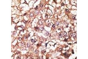 IHC analysis of FFPE human hepatocarcinoma stained with the STUB1 antibody (STUB1 anticorps  (AA 203-231))