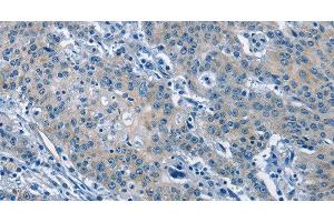 Immunohistochemistry of paraffin-embedded Human gastric cancer tissue using GAS2 Polyclonal Antibody at dilution 1:50 (GAS2 anticorps)