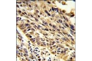 Formalin-fixed and paraffin-embedded human lung carcinoma reacted with TRIP13 Antibody (N-term) (ABIN389357 and ABIN2839463) , which was peroxidase-conjugated to the secondary antibody, followed by DAB staining.