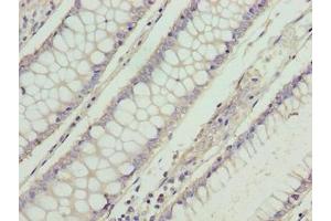Immunohistochemistry of paraffin-embedded human colon cancer using ABIN7166002 at dilution of 1:100 (RD3 anticorps  (AA 1-195))