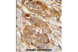 GRINA Antibody (Center) (ABIN657481 and ABIN2846508) immunohistochemistry analysis in formalin fixed and paraffin embedded human breast carcinoma followed by peroxidase conjugation of the secondary antibody and DAB staining. (GRINA anticorps  (AA 131-158))