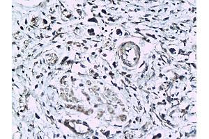 Formalin-fixed and paraffin embedded human colorectal cancer labeled with Anti-phospho-KLF5(Ser275) Polyclonal Antibody, Unconjugated (ABIN676778) followed by conjugation to the secondary antibody and DAB staining (KLF5 anticorps  (pSer275))
