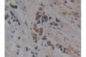 Detection of MAPT in Human Breast cancer Tissue using Polyclonal Antibody to Tau Protein (MAPT)