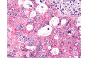 Anti-FZD6 / Frizzled 6 antibody IHC of human Lung, Non-Small Cell Carcinoma. (FZD6 anticorps  (N-Term))
