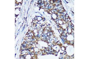 Immunohistochemistry of paraffin-embedded Human colon carcinoma using CDKL3 Rabbit pAb (ABIN7266612) at dilution of 1:100 (40x lens). (CDKL3 anticorps  (AA 1-120))