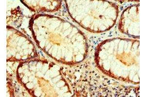 IHC analysis of paraffin-embedded human colon cancer tissue, using IDH1 antibody (1/100 dilution). (IDH1 anticorps  (AA 1-240))