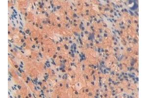 Detection of OIT3 in Human Lung cancer Tissue using Polyclonal Antibody to Oncoprotein Induced Transcript 3 (OIT3)