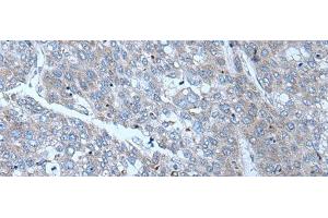 Immunohistochemistry of paraffin-embedded Human liver cancer tissue using SLC24A5 Polyclonal Antibody at dilution of 1:50(x200) (SLC24A5 anticorps)
