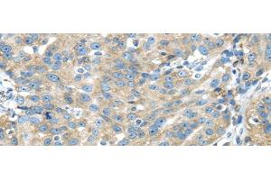 Immunohistochemistry of paraffin-embedded Human breast cancer using TXNDC5 Polyclonal Antibody at dilution of 1/40 (TXNDC5 anticorps)