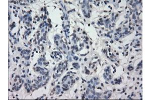 Immunohistochemical staining of paraffin-embedded breast tissue using anti-IRF3 mouse monoclonal antibody. (IRF3 anticorps)