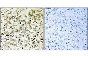 Immunohistochemistry analysis of paraffin-embedded human breast carcinoma tissue, using CTDSP1 Antibody.