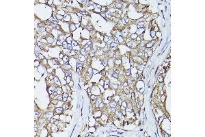 Immunohistochemistry of paraffin-embedded human lung cancer using P4HB antibody (ABIN6134876 and ABIN6145140) at dilution of 1:150 (40x lens). (P4HB anticorps)