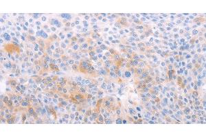 Immunohistochemistry of paraffin-embedded Human liver cancer using EDG6 Polyclonal Antibody at dilution of 1:40 (S1PR4 anticorps)