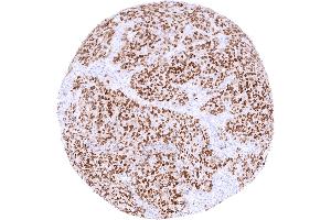 Invasive breast cancer of no special type NST with distinct SOX10 positivity of tumor cells (Recombinant SOX10 anticorps)