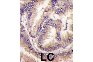 Formalin-fixed and paraffin-embedded human lung carcinoma tissue reacted with CDKL5 polyclonal antibody  , which was peroxidase-conjugated to the secondary antibody, followed by DAB staining. (CDKL5 anticorps  (C-Term))