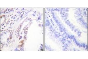 Immunohistochemistry analysis of paraffin-embedded human lung carcinoma tissue, using AML1 (Ab-303) Antibody. (RUNX1 anticorps  (AA 269-318))