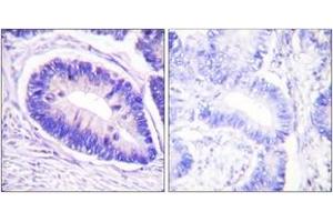 Immunohistochemistry analysis of paraffin-embedded human colon carcinoma, using MYPT1 (Phospho-Thr853) Antibody. (PPP1R12A anticorps  (pThr853))