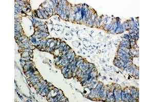 IHC-P: PRDX3 antibody testing of human intestinal cancer tissue