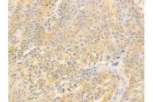 ABIN7095803 and ABIN7099865 at 1/100 staining human lung squamous cell carcinoma by IHC-P. (CARS2 anticorps)