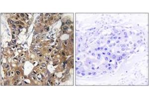Immunohistochemistry analysis of paraffin-embedded human breast carcinoma tissue, using CD9 Antibody. (CD9 anticorps  (AA 101-150))