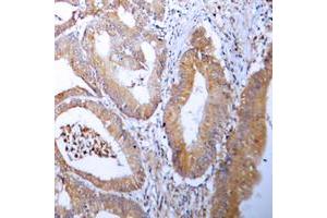 Immunohistochemical analysis of ACC alpha staining in human colon cancer formalin fixed paraffin embedded tissue section.
