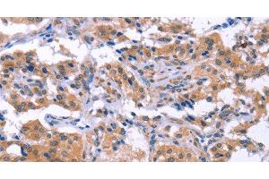 Immunohistochemistry of paraffin-embedded Human thyroid cancer using ESPL1 Polyclonal Antibody at dilution of 1:40 (Separase anticorps)