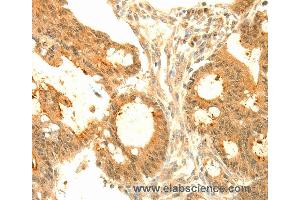 Immunohistochemistry of Human gastric cancer using SOCS6 Polyclonal Antibody at dilution of 1:50 (SOCS6 anticorps)