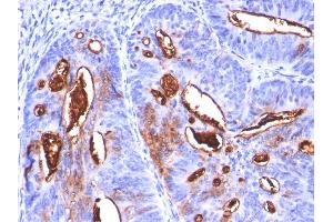 Formalin-fixed, paraffin-embedded human Colon Carcinoma stained with CA19-9 Monoclonal Antibody (SPM588). (CA 19-9 anticorps)