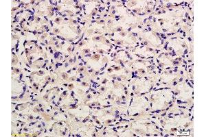 Formalin-fixed and paraffin embedded human gastric adenocarcinoma labeled with Rabbit Anti-CD45/B220 Polyclonal Antibody, Unconjugated  at 1:200 followed by conjugation to the secondary antibody and DAB staining.