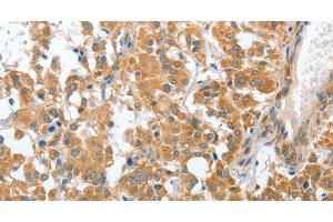 Immunohistochemistry of paraffin-embedded Human thyroid cancer tissue using CHMP4B Polyclonal Antibody at dilution 1:40 (CHMP4B anticorps)
