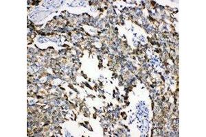 Anti-Grp75 antibody, IHC(P) IHC(P): Human Lung Cancer Tissue (HSPA9 anticorps  (C-Term))