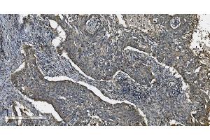 IHC analysis of MAP3K8 using anti-MAP3K8 antibody (ABIN4886663). (MAP3K8 anticorps  (AA 9-193))