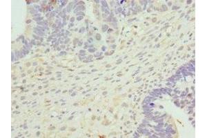 Immunohistochemistry of paraffin-embedded human ovarian cancer using ABIN7149288 at dilution of 1:100 (Cytohesin 2 anticorps  (AA 150-350))