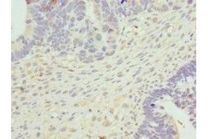 Immunohistochemistry of paraffin-embedded human ovarian cancer using ABIN7149288 at dilution of 1:100