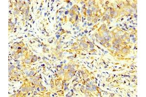 IHC image of ABIN7166908 diluted at 1:400 and staining in paraffin-embedded human pancreatic cancer performed on a Leica BondTM system. (PKM anticorps  (AA 185-461))