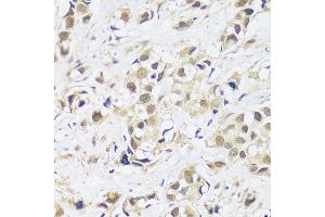 Immunohistochemistry of paraffin-embedded human breast cancer using  antibody (ABIN7265374) at dilution of 1:100 (40x lens). (ASCL4 anticorps  (AA 1-172))
