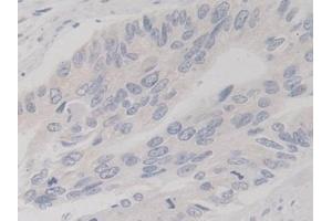 Detection of TBK1 in Human Colorectal cancer Tissue using Polyclonal Antibody to TANK Binding Kinase 1 (TBK1)