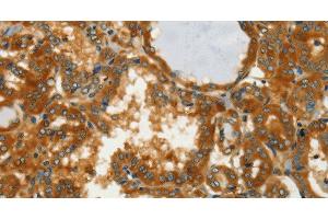 Immunohistochemistry of paraffin-embedded Human thyroid cancer using GOT1 Polyclonal Antibody at dilution of 1:50