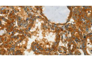 Immunohistochemistry of paraffin-embedded Human thyroid cancer using GOT1 Polyclonal Antibody at dilution of 1:50 (GOT1 anticorps)