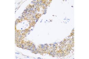 Immunohistochemistry of paraffin-embedded human colon carcinoma using ZAK antibody (ABIN6133445, ABIN6150360, ABIN6150361 and ABIN6223229) at dilution of 1:100 (40x lens).
