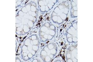 Immunohistochemistry of paraffin-embedded human colon carcinoma using UBE2L6 Rabbit pAb (ABIN1683197, ABIN3018773, ABIN3018774 and ABIN7101658) at dilution of 1:250 (40x lens).