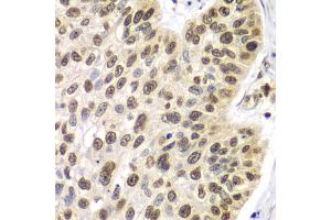 Immunohistochemistry of paraffin-embedded human lung cancer using SEPT7 antibody.